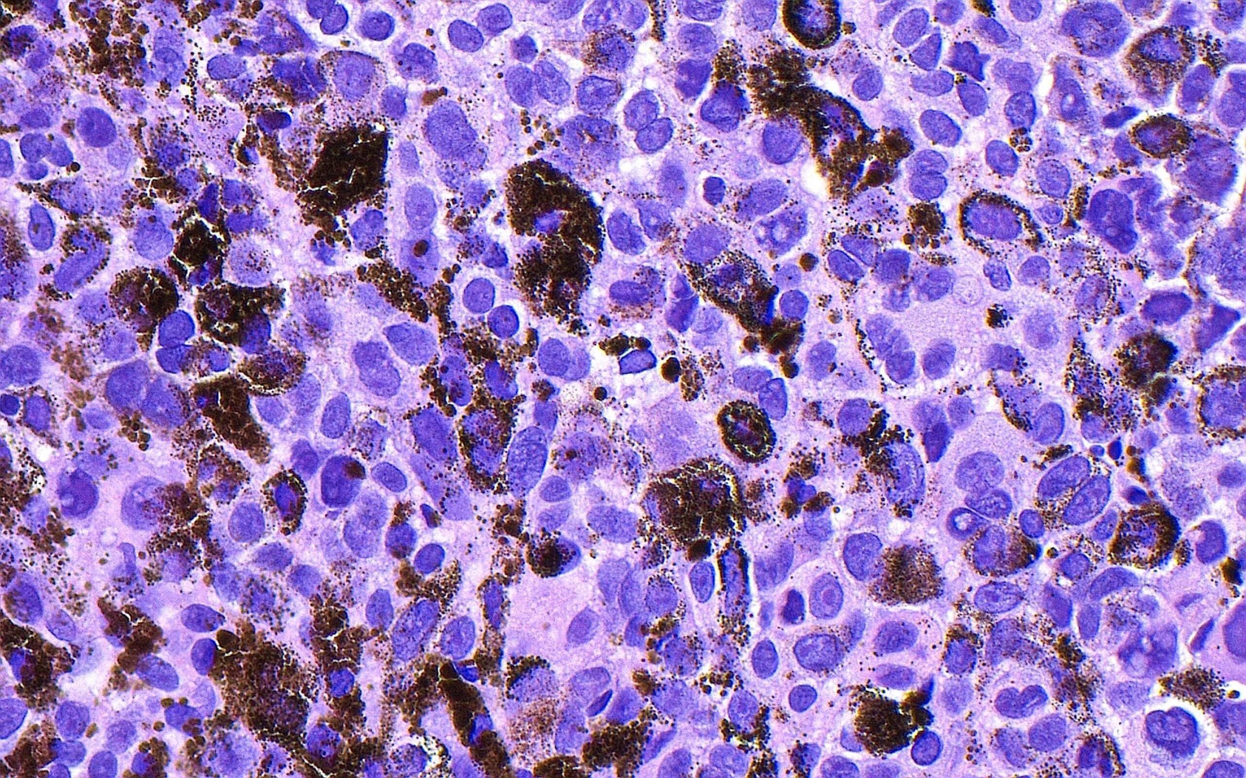 <i>Ziad M. El-Zaatari/Science Photo Library/Getty Images via CNN Newsource</i><br/>Merck and Moderna released results of a late-stage trial that showed an experimental mRNA vaccine slashed the risk that melanoma returns by 42%.